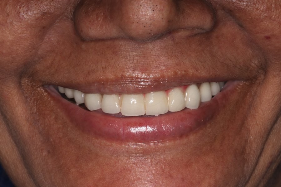 Full Mouth Rehabilitation Case Before