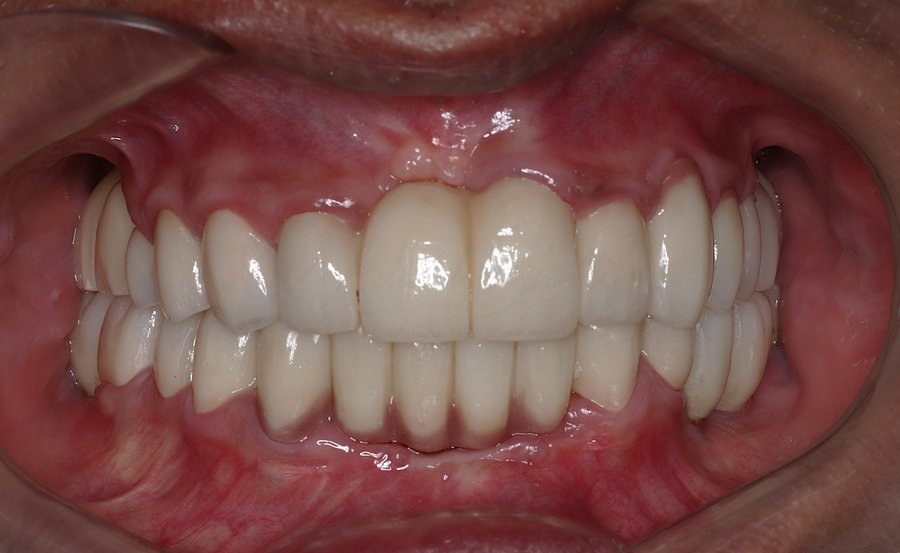 Full Mouth Rehabilitation Case 2 After