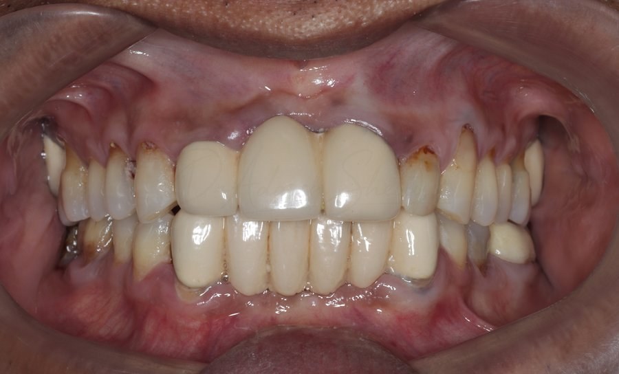 Full Mouth Rehabilitation Case 2 Before