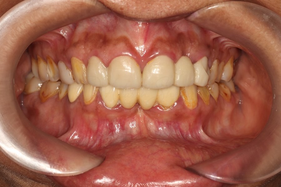 Full Mouth Rehabilitation Case 3 Before