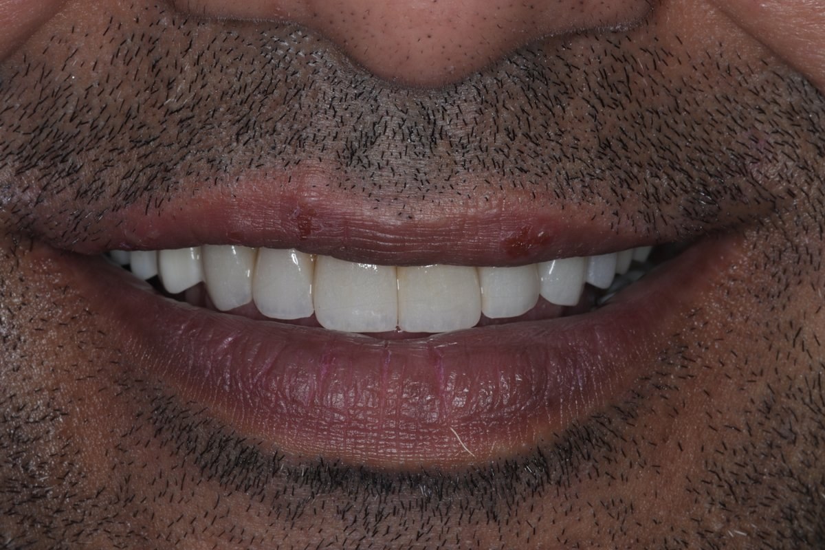 Smile Designing Case 1 After