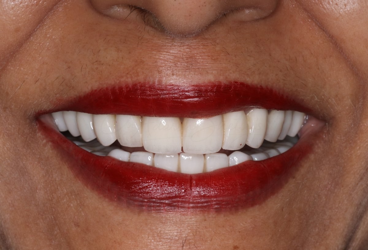 Smile Designing Case 5 After