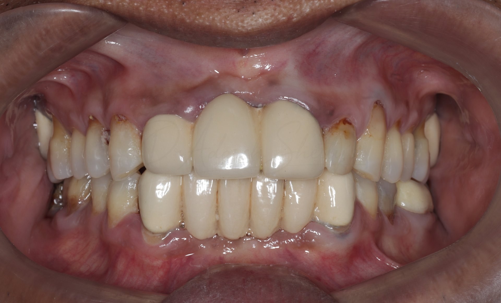 FMR Case 1 Before