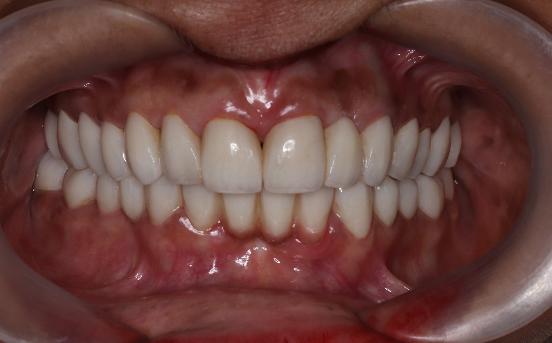 FMR Case 2 After