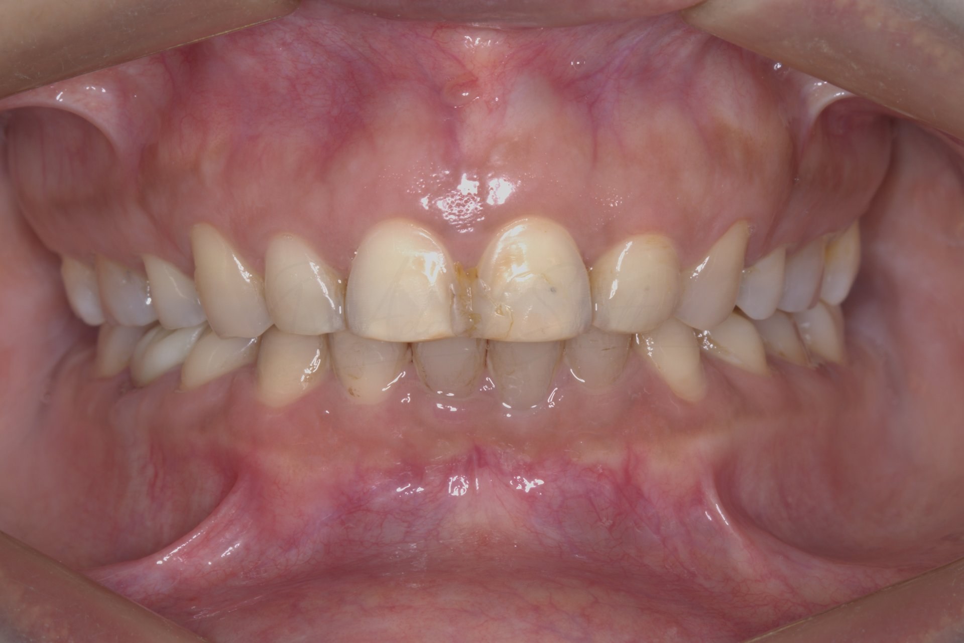 FMR Case 3 After