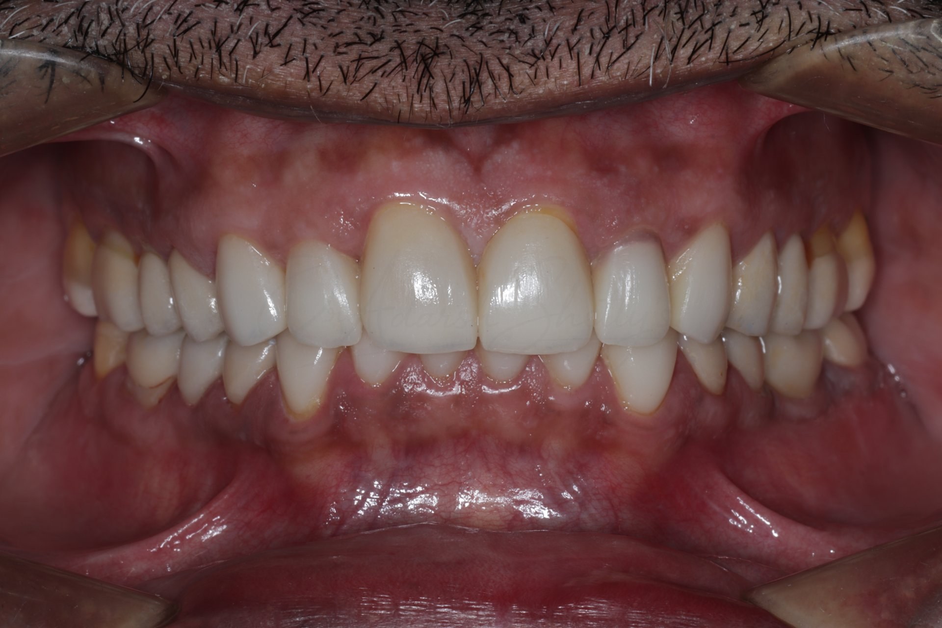 FMR Case 4 After