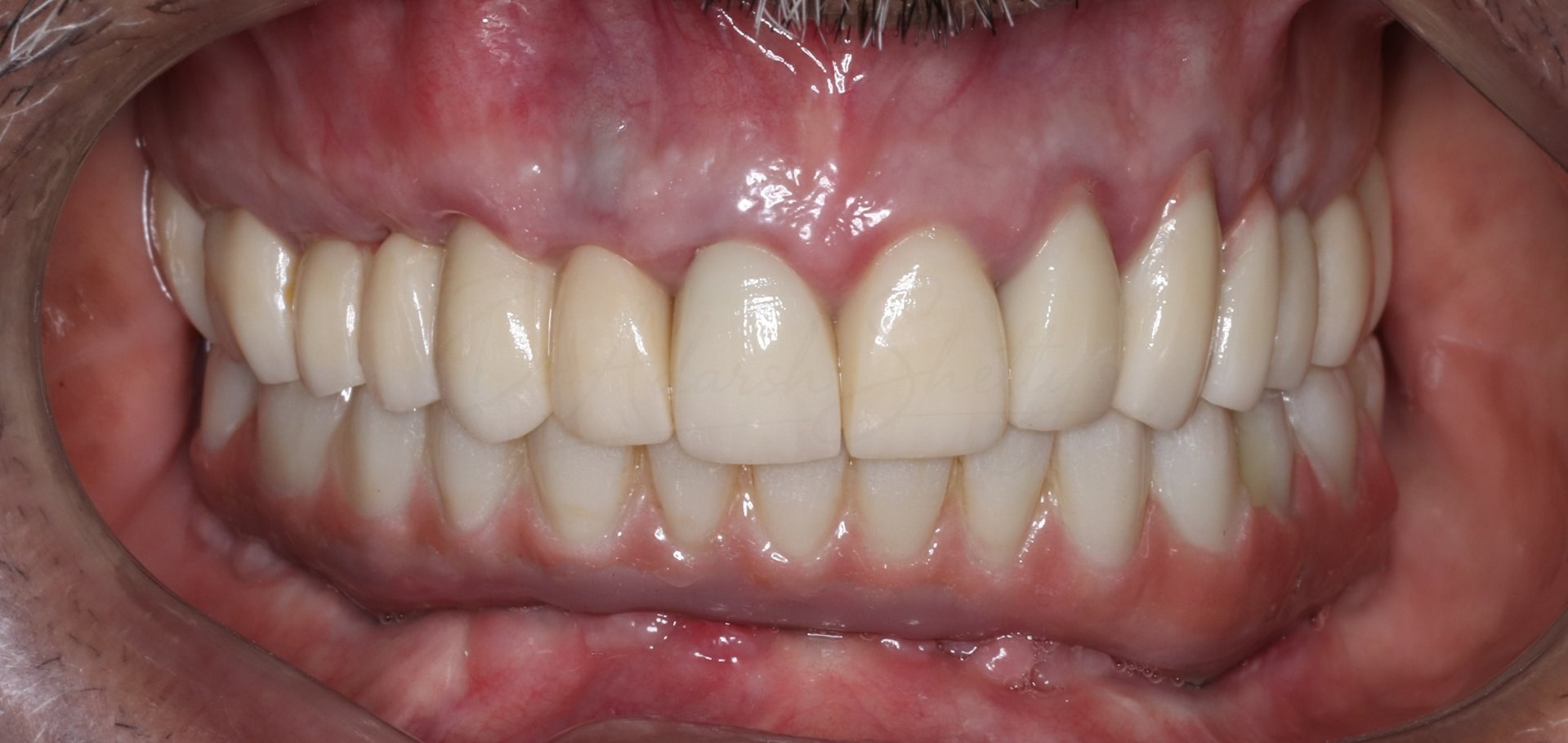 FMR Case 5 After