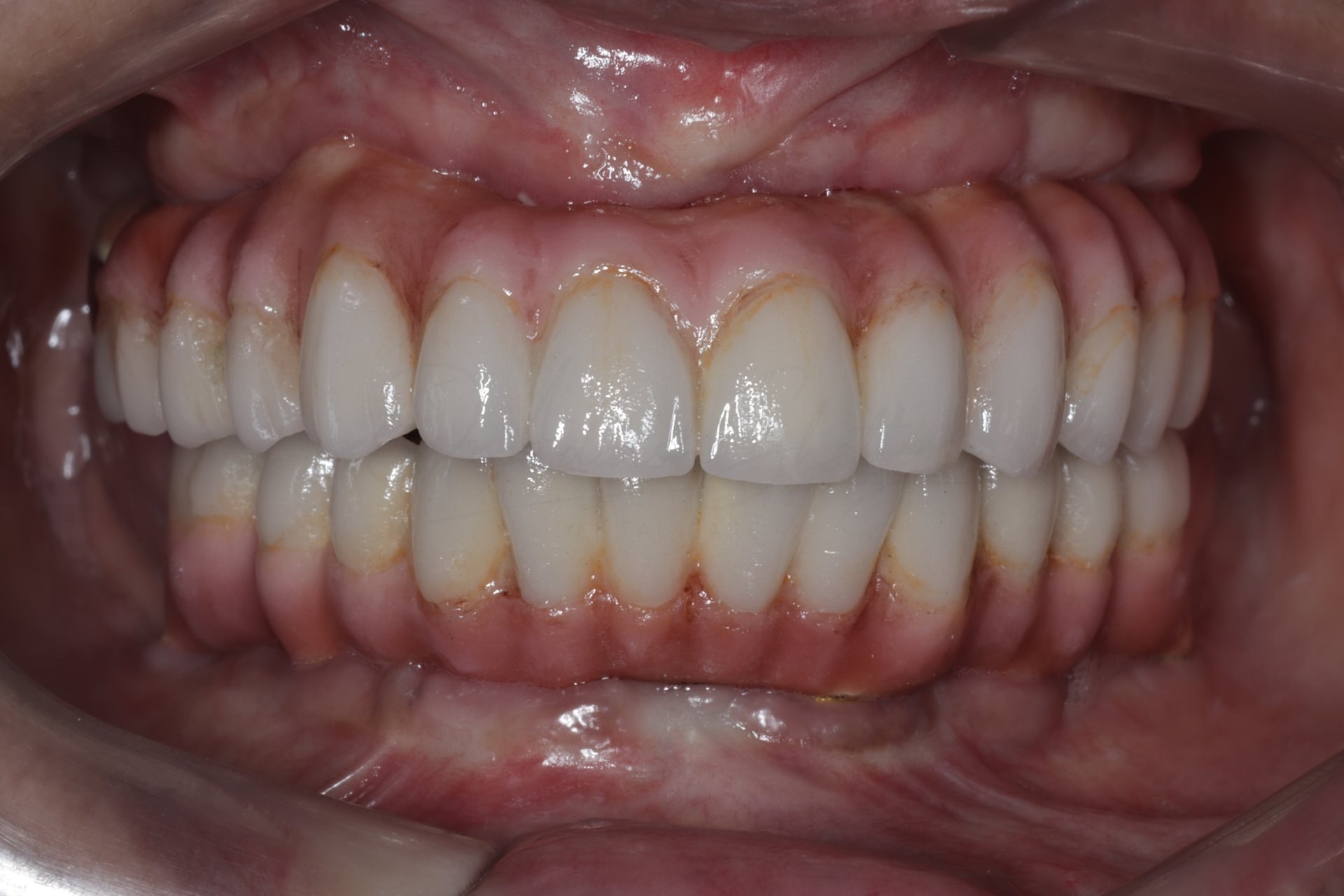FMR Case 6 After
