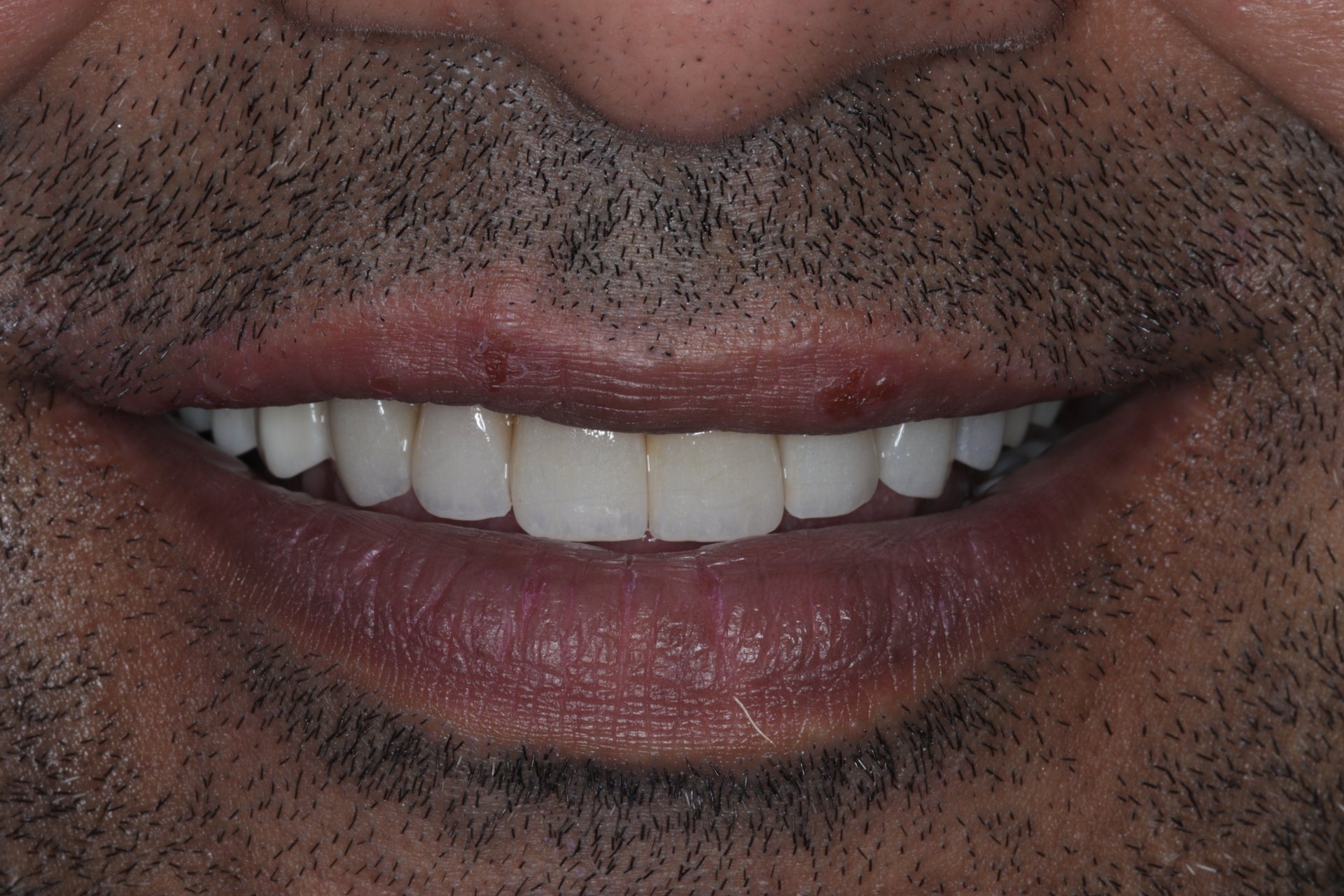 Smile Designing Case 1 After