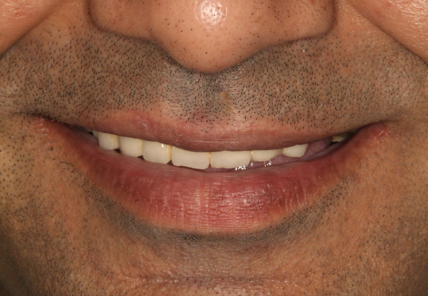 Smile Designing Case 1 Before