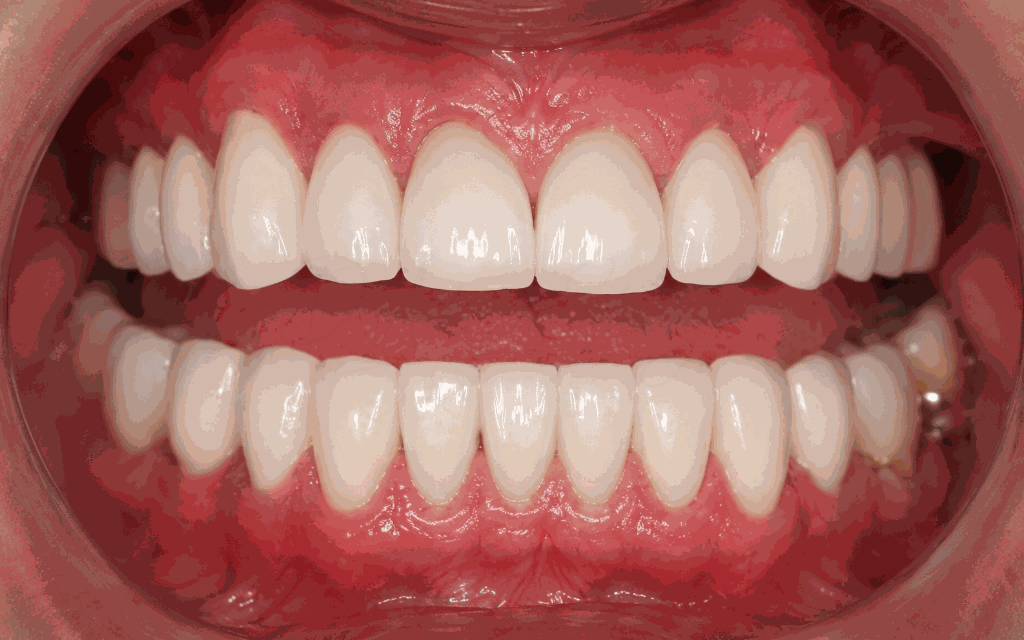 Worn Dentition Case 2 After
