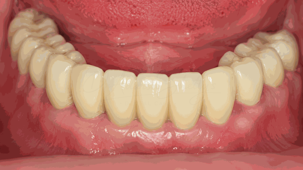Implant Reconstruction Case 4 After