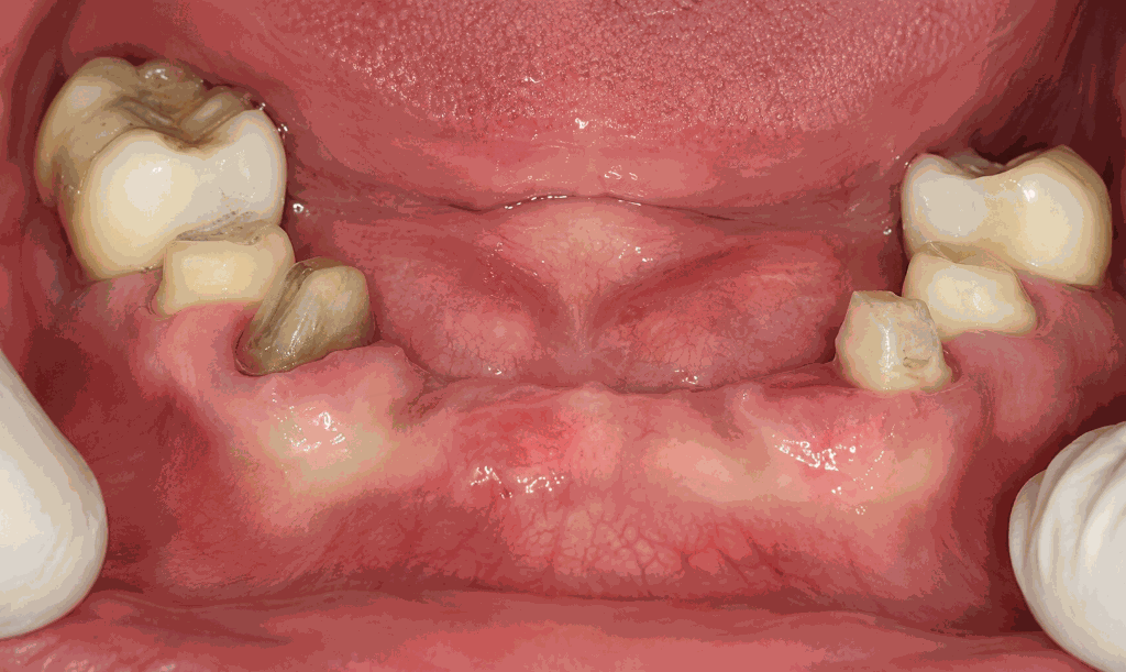 Implant Reconstruction Case 4 Before