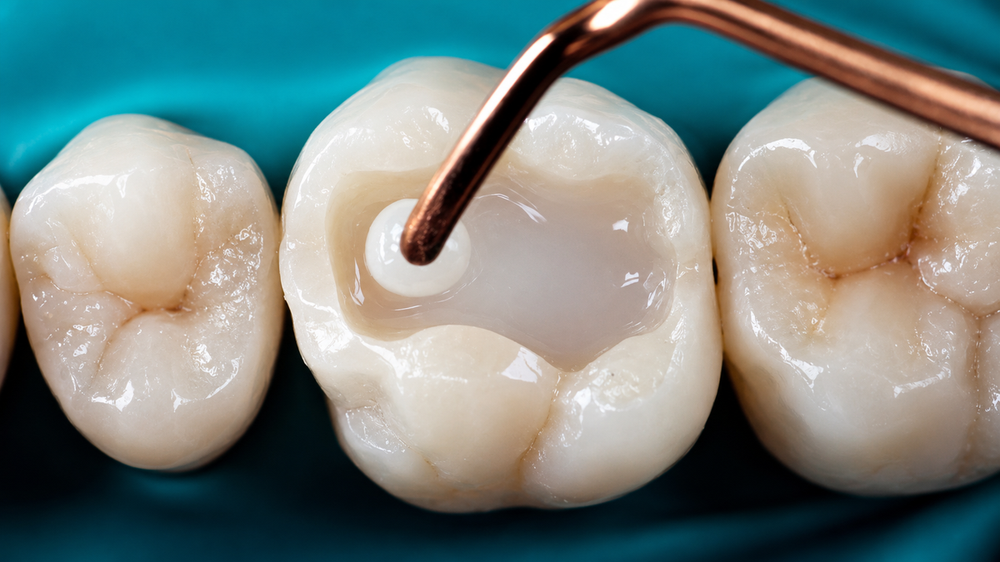 Composite Veneers