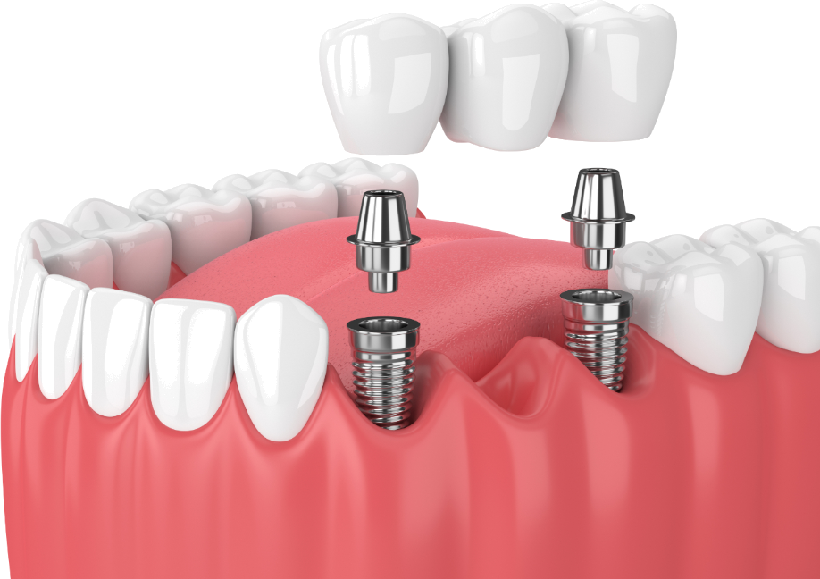 Dental Implants